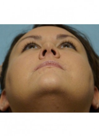 Crooked Nose Endonasal Technique2* — After