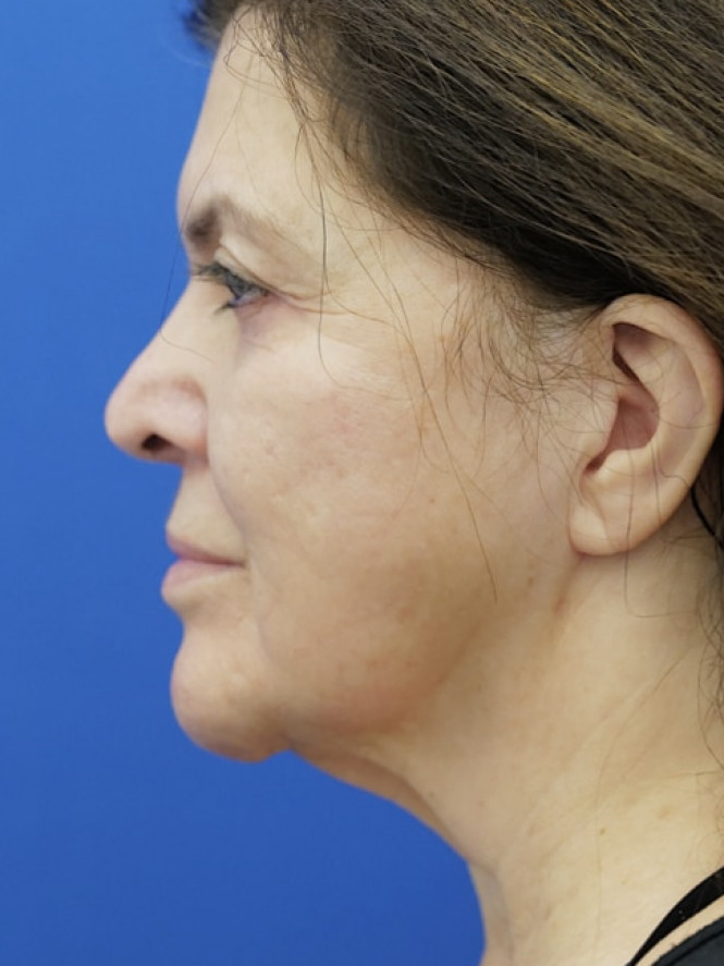 Lower Facelift Chin Reduction — Before