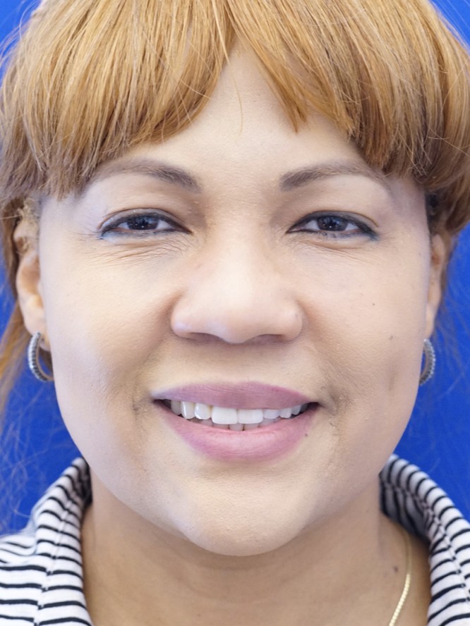 Narrow Widened Nose — Before