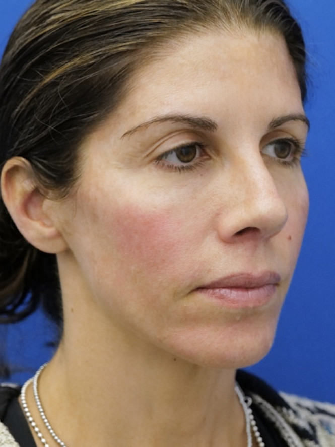 Brow Tip Aesthetic Line — After