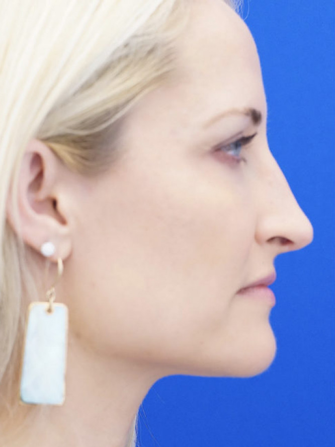 Nasal Profile Finesse — Before