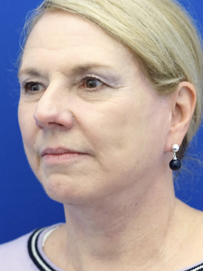 Lower Facial Aging and Fullness — After