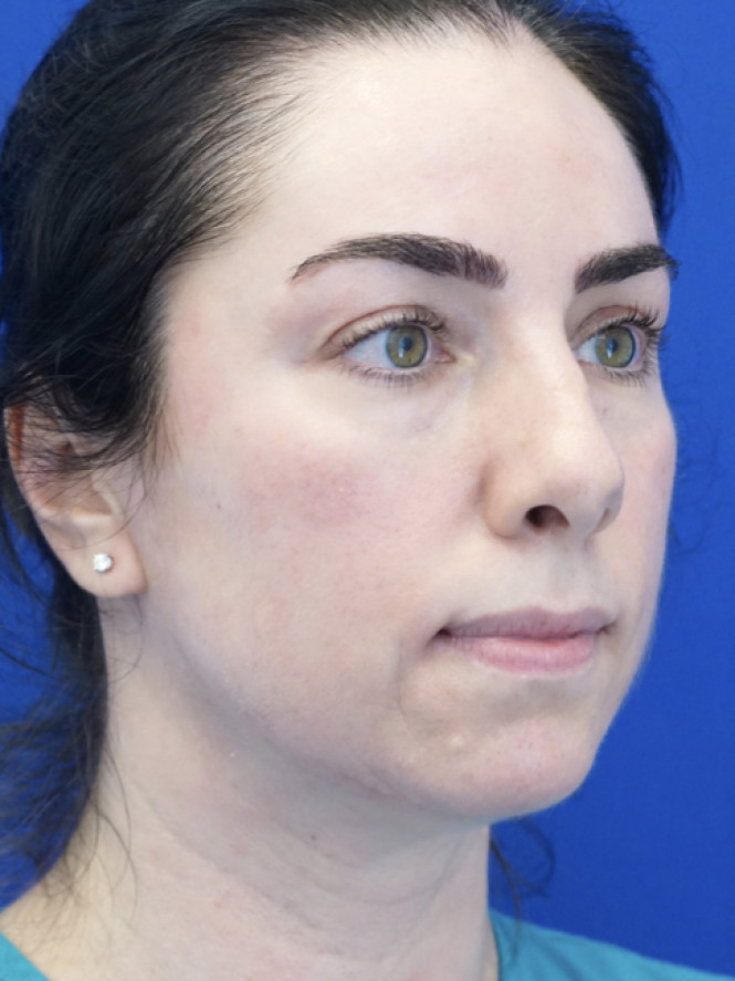 Tip Asymmetry — Before