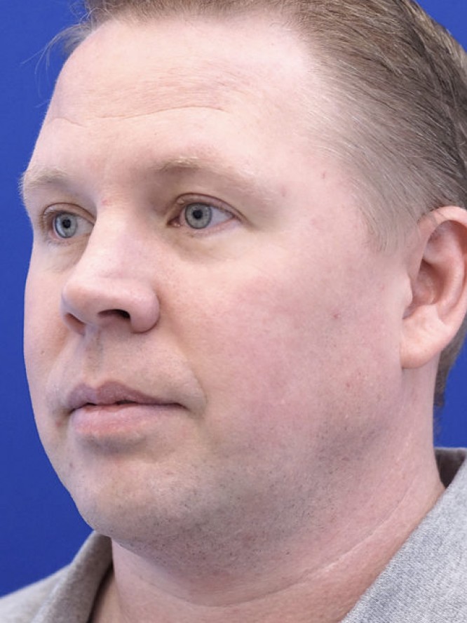 Mild Nasal Deviation — After