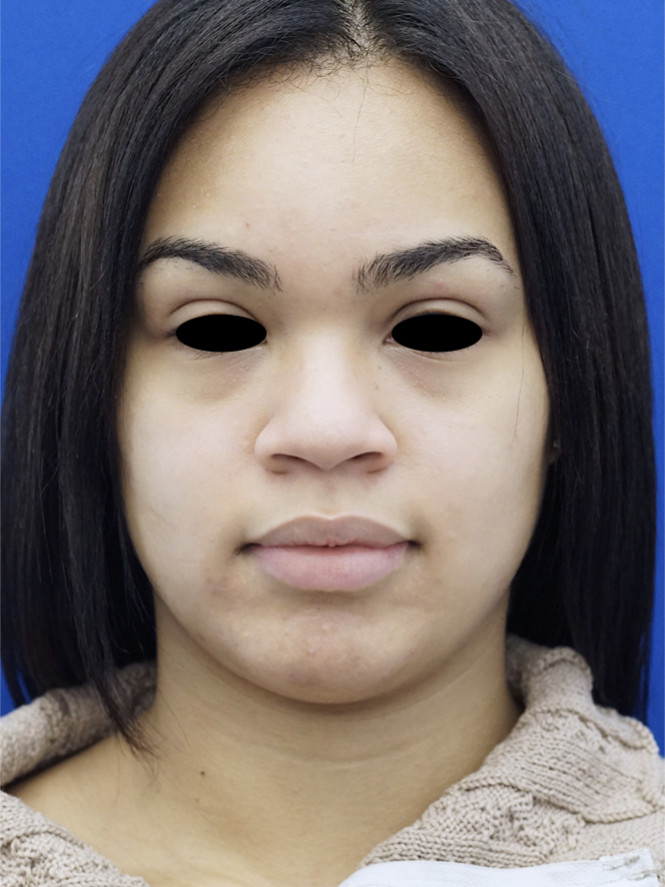 Narrow Nasal Base and Sill — Before
