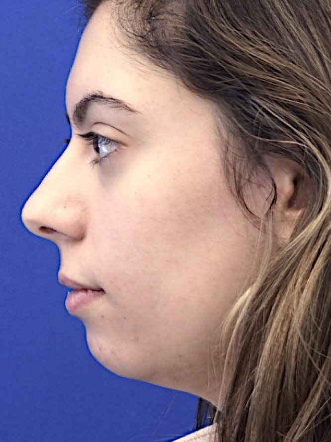 Hump Reduction and Chin Projection — Before