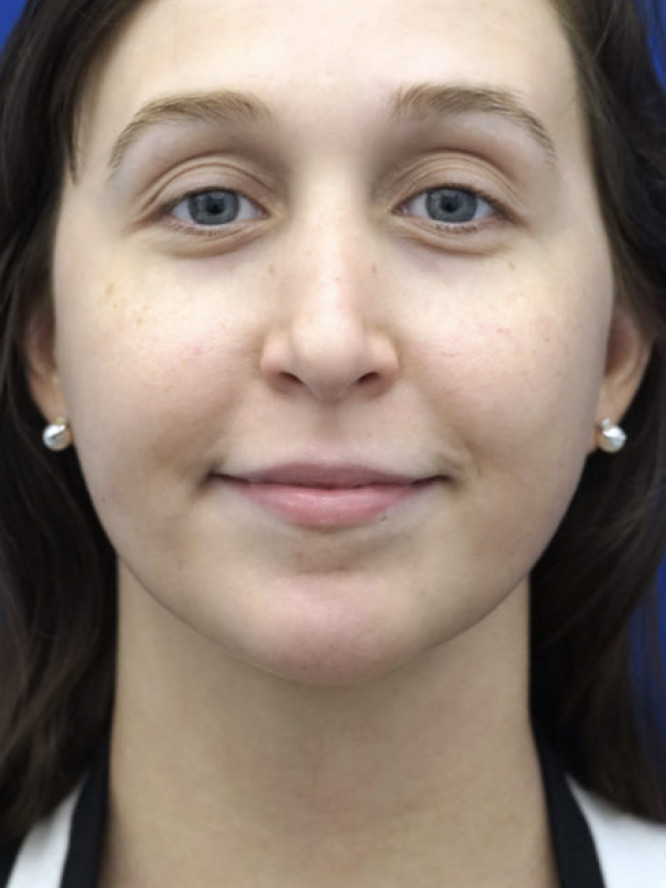 Necklift Subplatysmal Lipectomy — After