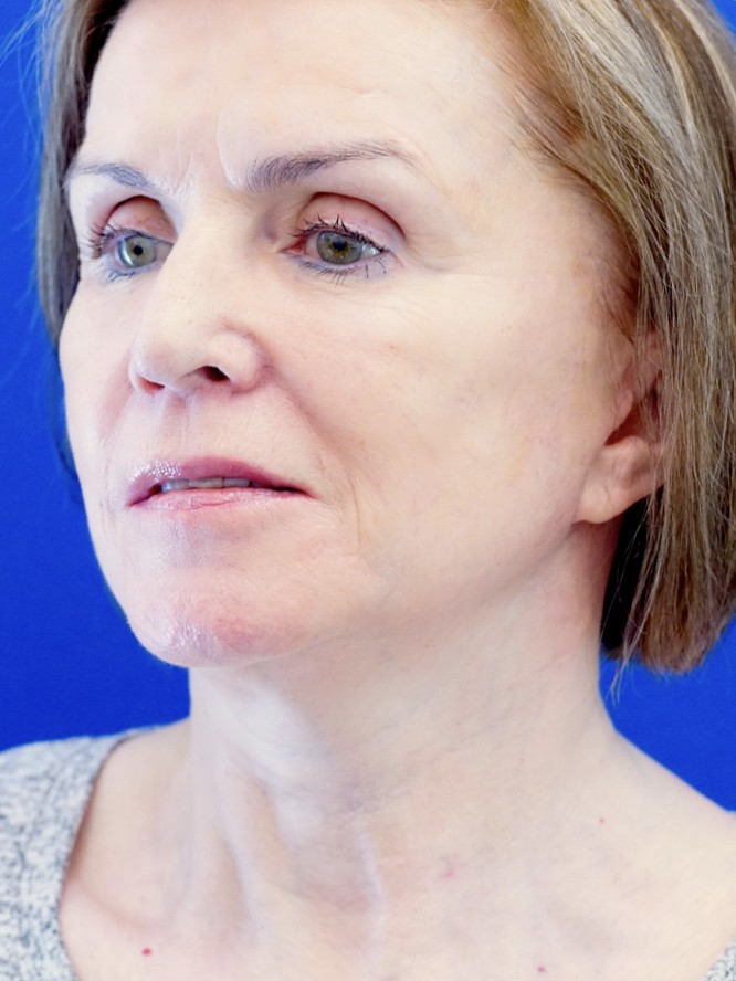 Deep Plane Lift and Fat Grafting — After