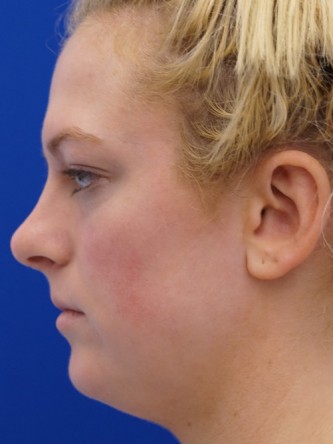 Restylane Silk Equalizes Lip Volume* — Before