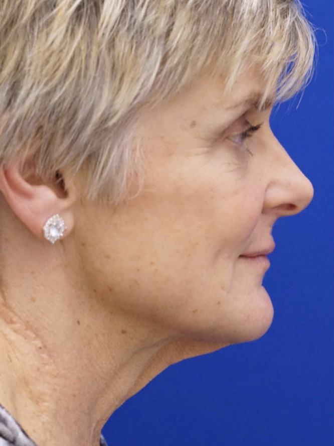 Lower Facelift Deep Plane — Before