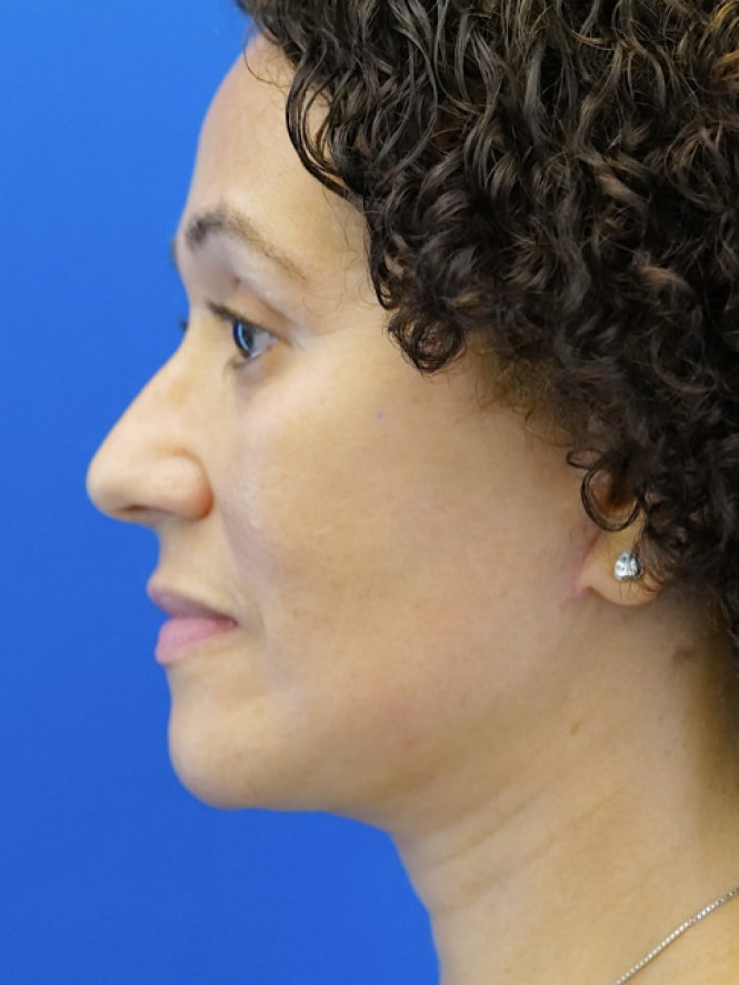 Deep Plane Full Facelift — After