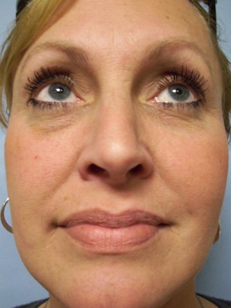 Mild Dorsal Hump & Droopy Tip2* — After