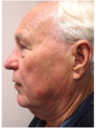 Aging Eyelid Rejuvenation, Facelift, Necklift 3* — Before