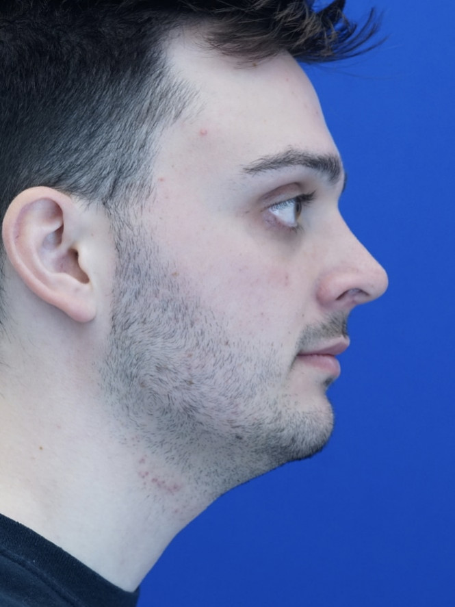 Profile Enhancement — After
