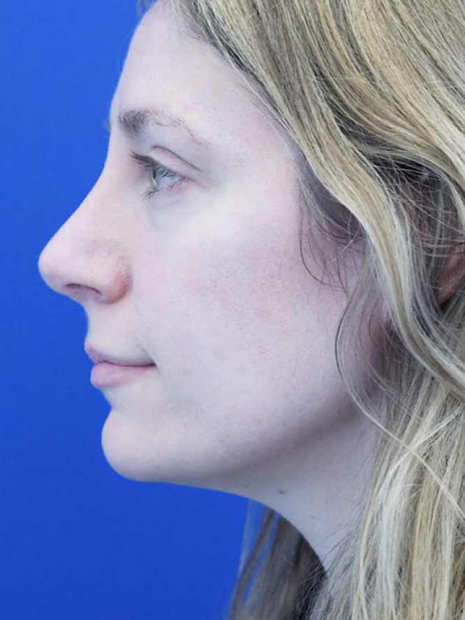 Nasal Profile Finesse — After