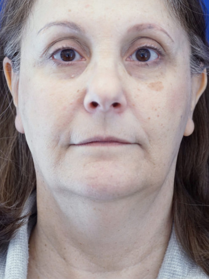 Deep Plane Facelift and Platysmaplasty — Before