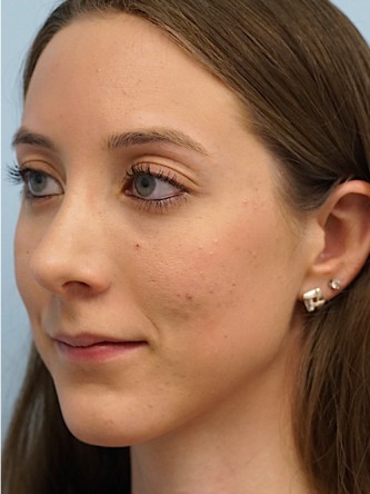 Nasal Hump Endonasal Rhinoplasty* — After