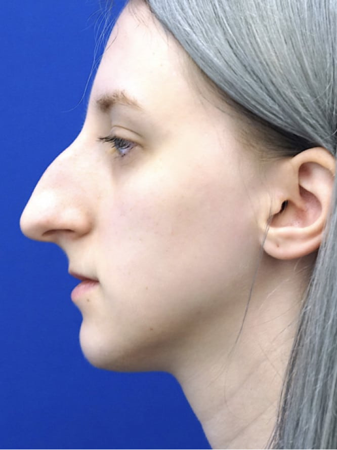 Dorsal Hump and Tension Tip — Before
