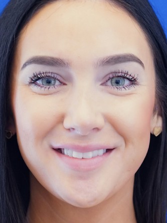 Nasal Hump Closed Rhinoplasty — After