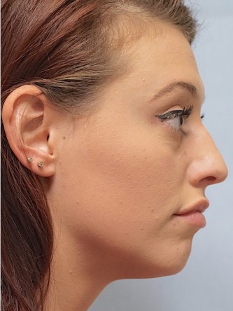Cupid’s Bow Enhancement by Juvederm* — After