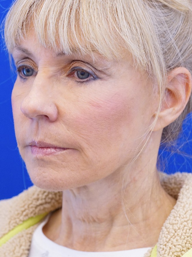 Neck Rejuvenation — Before