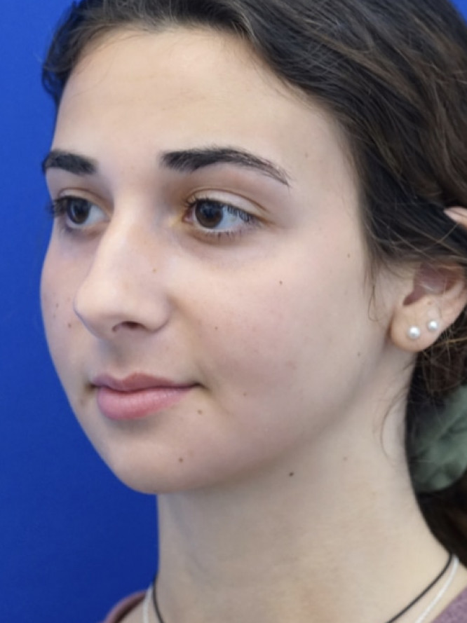 Classic Tension Nose — Before