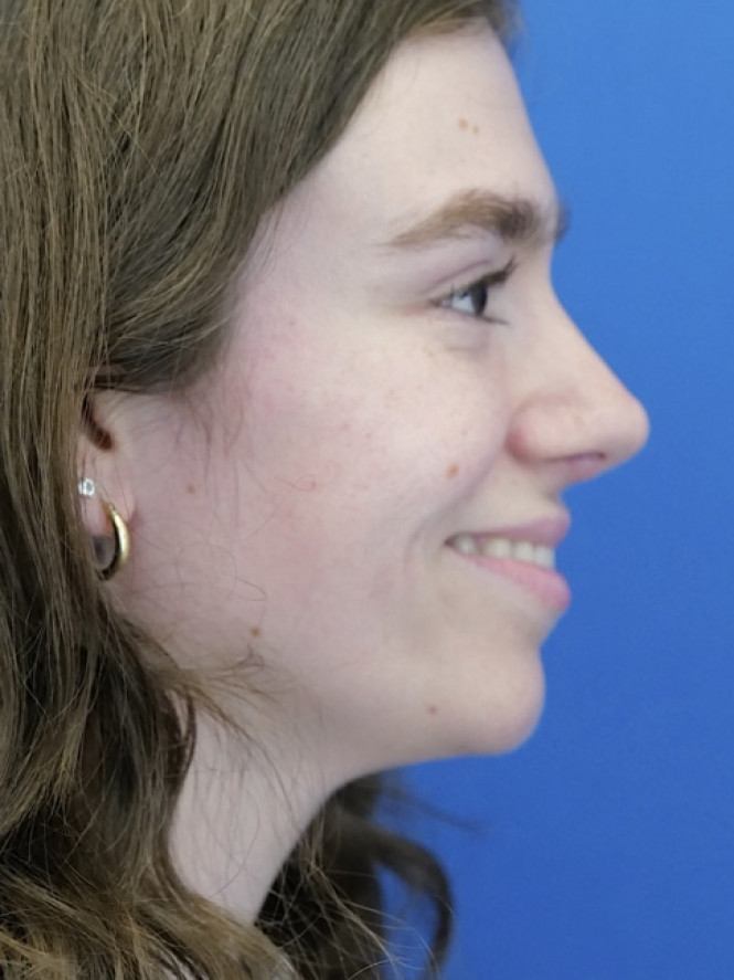 Preservation Rhinoplasty1 — After