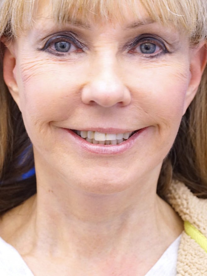 Neck Rejuvenation — After
