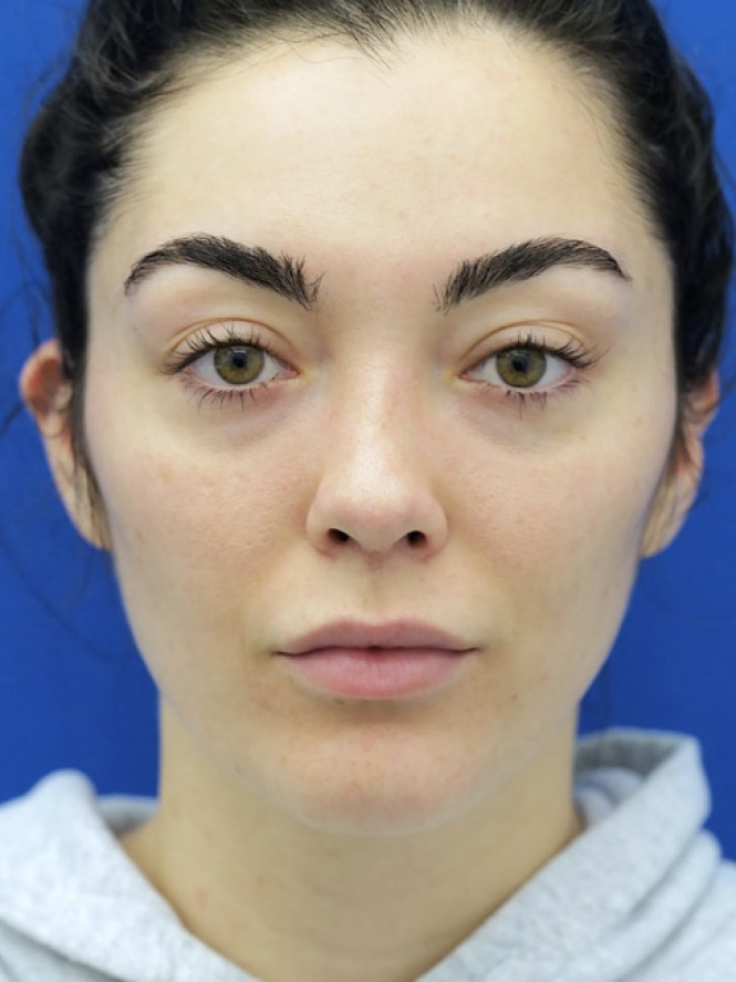 Ideal Nasal Profile — After