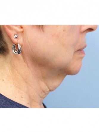 Neck Lift* — Before