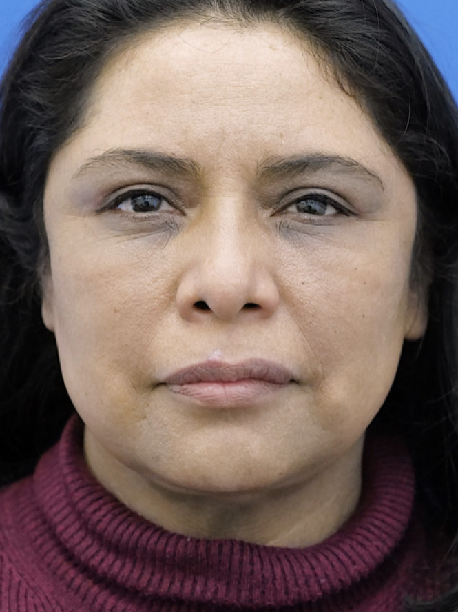 Four-Lid Blepharoplasty — After
