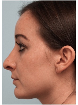 Droopy Tip – Revision* — Before