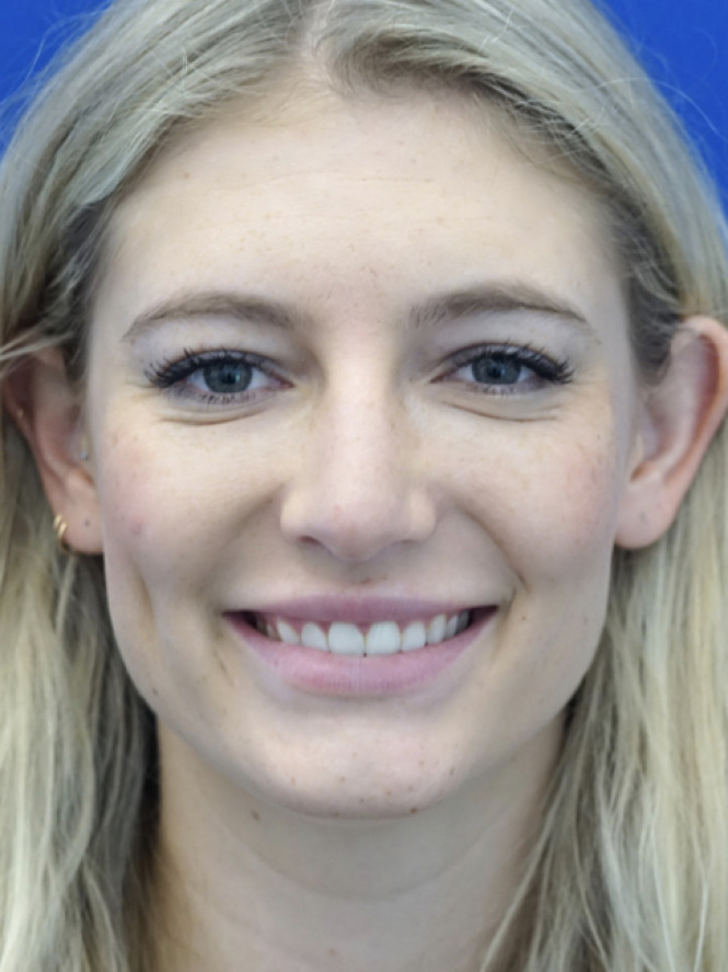 Aesthetic Nasal Contour — Before