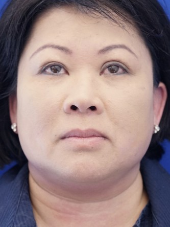 Asian Blepharoplasty — After