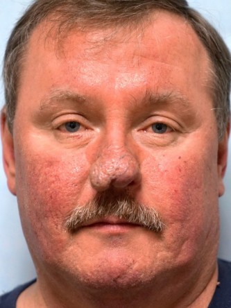 Rhinophyma* — Before