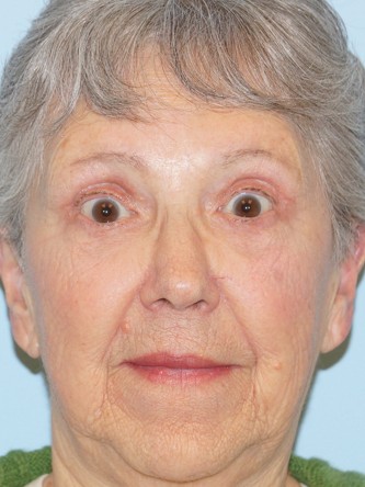 Endoscopic Browlift1* — After