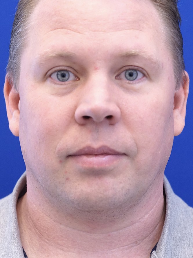 Mild Nasal Deviation — After