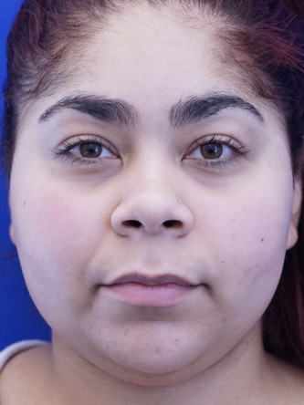 Restylane Silk Balances Lip Fullness* — Before