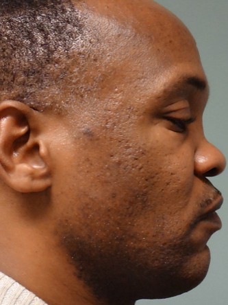 Saddle Nose – Repair Using Rib Cartilage* — Before