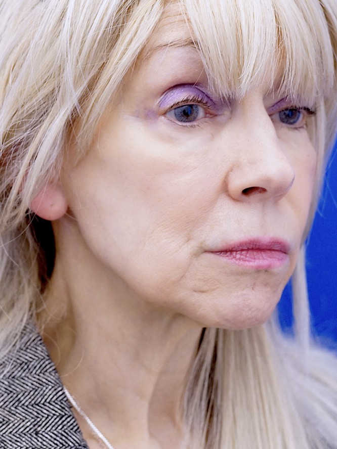 Crisp Jaw and Neck Lines — Before