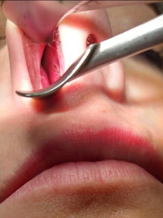 Repair of Nasal Septal Perforation* — After