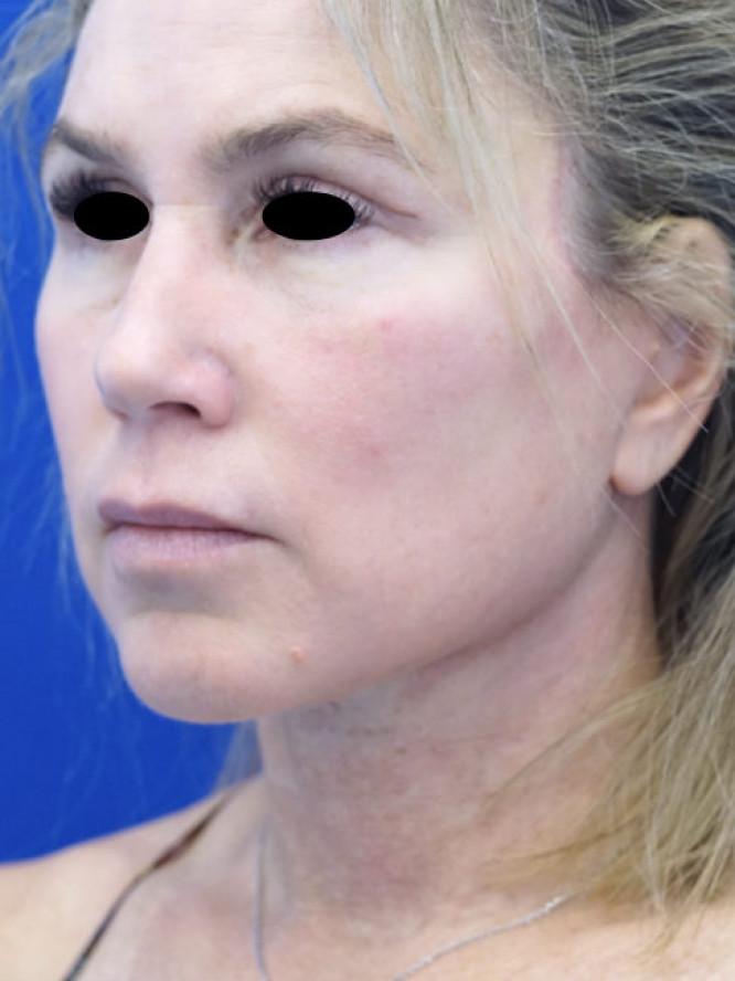 Deep Plane Facelift with Platysmaplasty — After