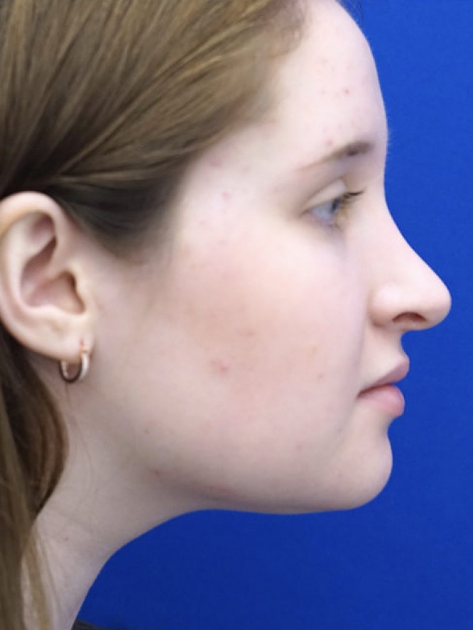 Reduction Dorsal Hump — After