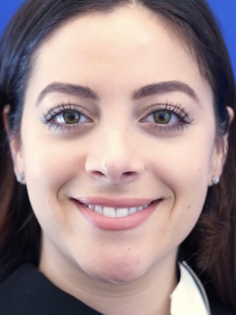 Finesse Nasal Aesthetics* — After