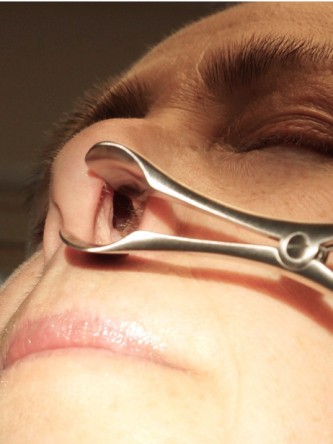 Nasal Septal Perforation2* — Before