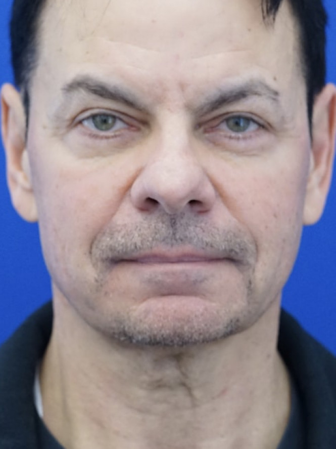 Neck Loose Skin — Before