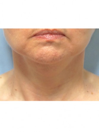 Neck Lift* — After