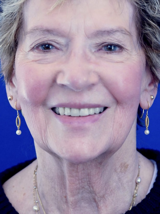 Deep Plane Facial Rejuvenation — Before