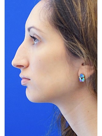 Nasal Profile Aesthetics — Before