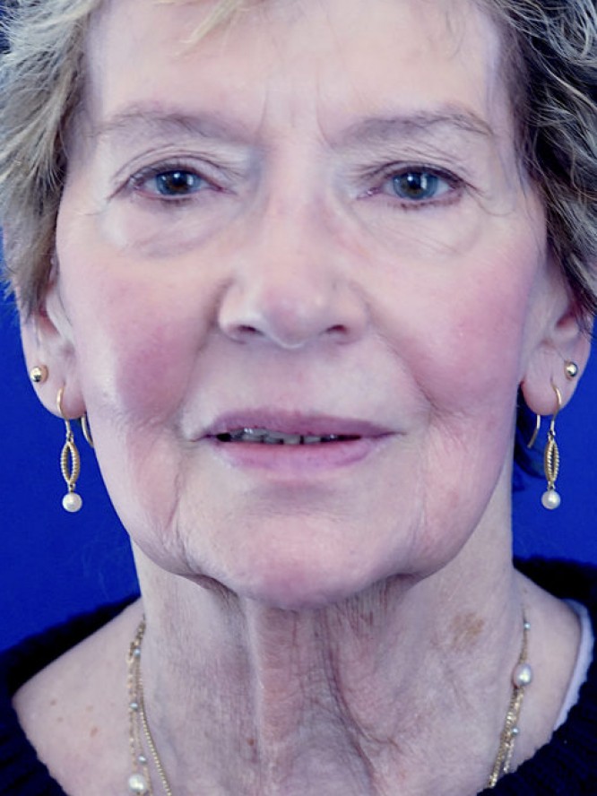 Deep Plane Facial Rejuvenation — Before